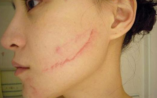 啤酒瓶爆炸，女服務(wù)員臉上留疤，餐廳和啤酒經(jīng)銷商都拒賠