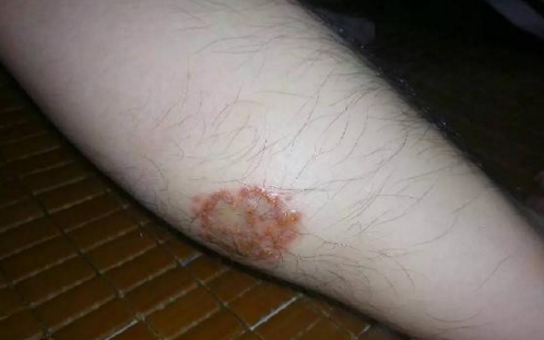 廚師小腿被蚊子叮潰爛 1年不愈合，竟是職業(yè)病引起的